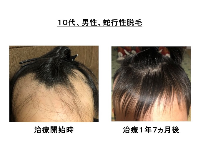 汎発性脱毛　病院